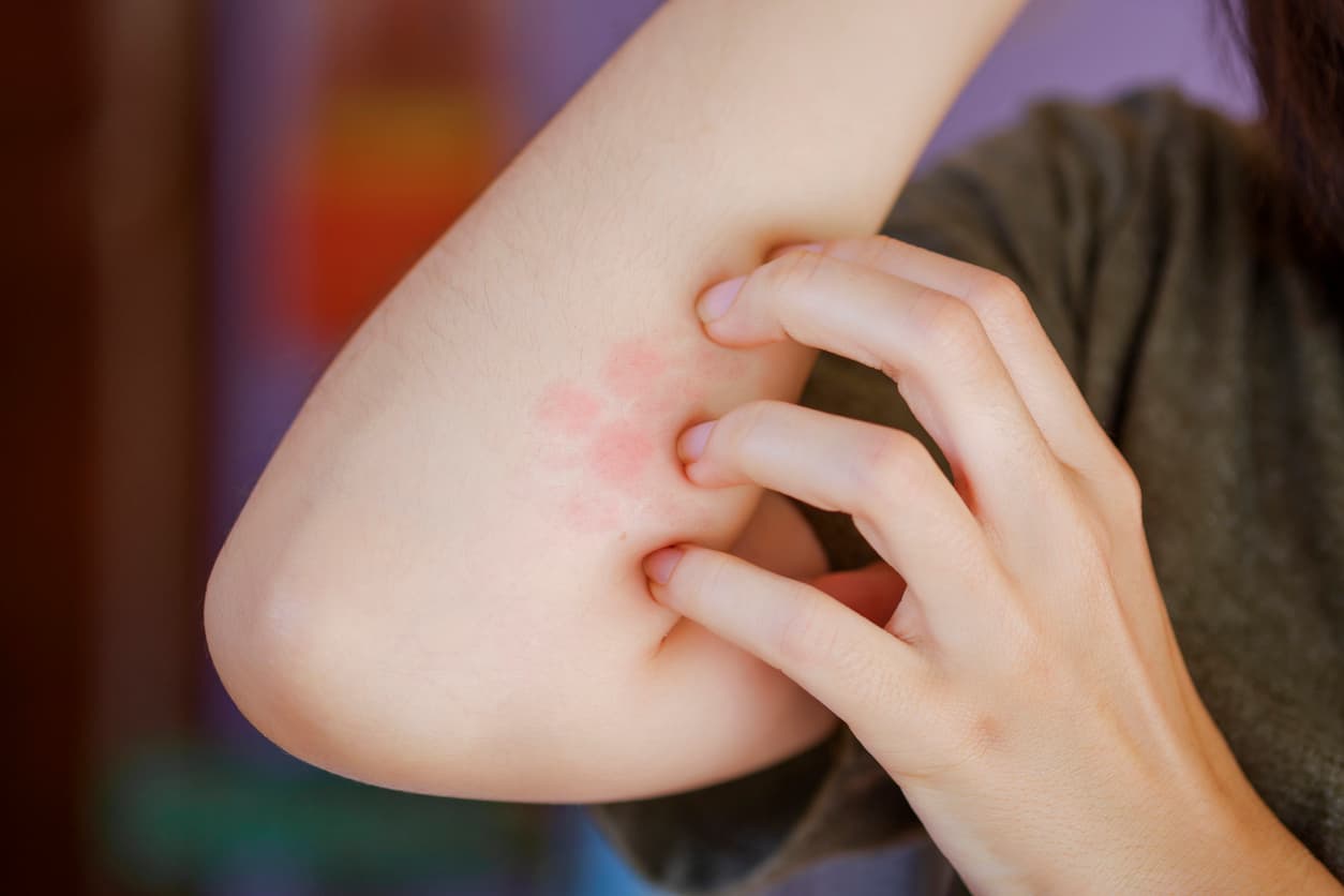 Don’t Scratch the Itch: How To Identify and Treat Bug Bites